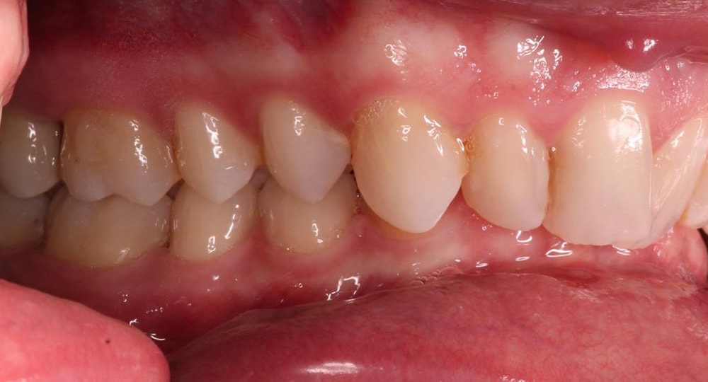 deep-bite-before-patient-1-1