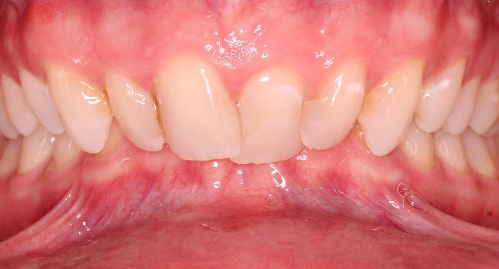 deep-bite-before-patient-1-2