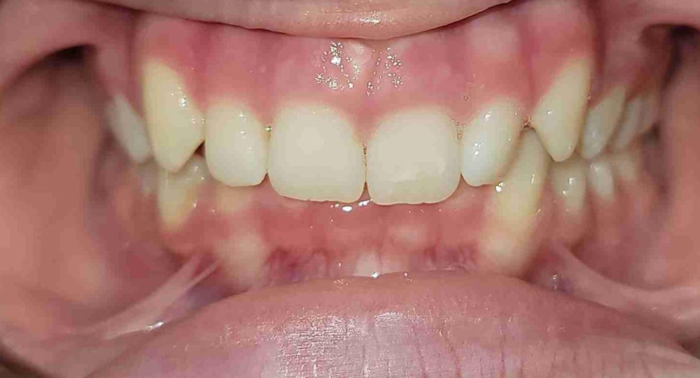 deep-bite-before-patient-2-2