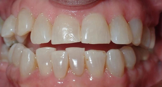 Openbite-Before-Patient-4-3
