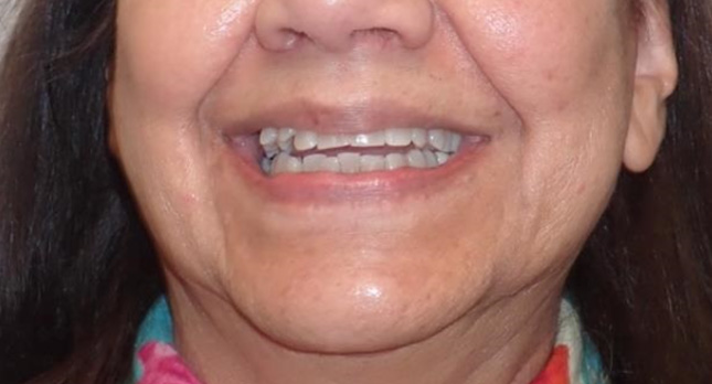 Openbite-Before-Patient-4-front