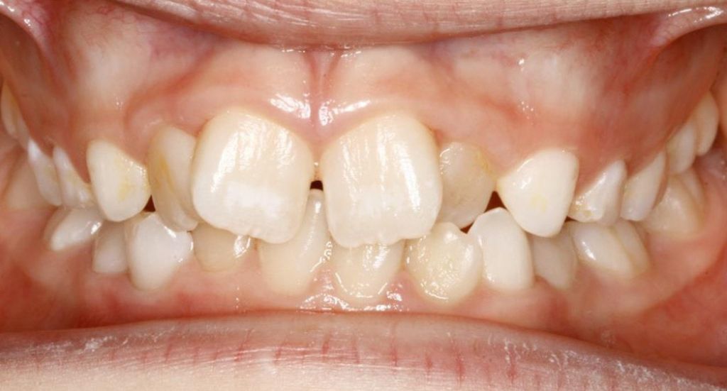 crossbite-Patient-3-Before-2