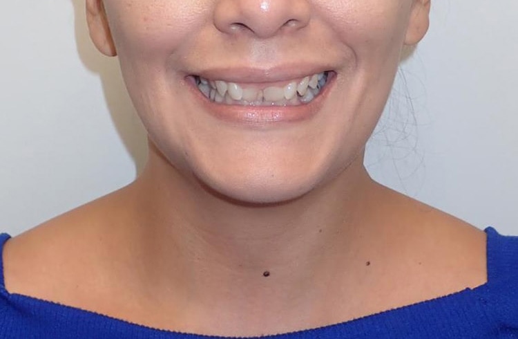 deep-bite-before-patient-3-front