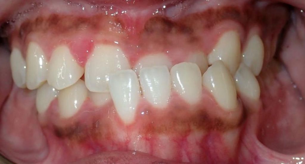 underbite-Patient-1-Before-2