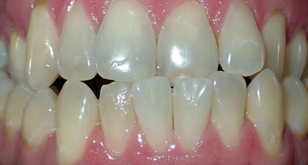 underbite-Patient-2-Before-3