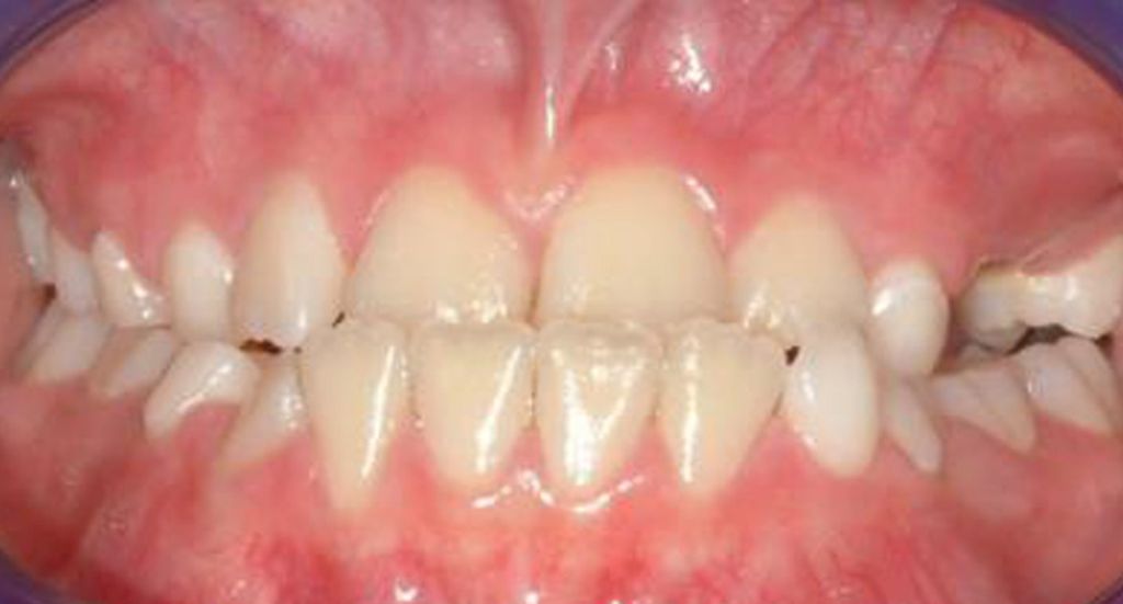 underbite-Patient-3-Before-1