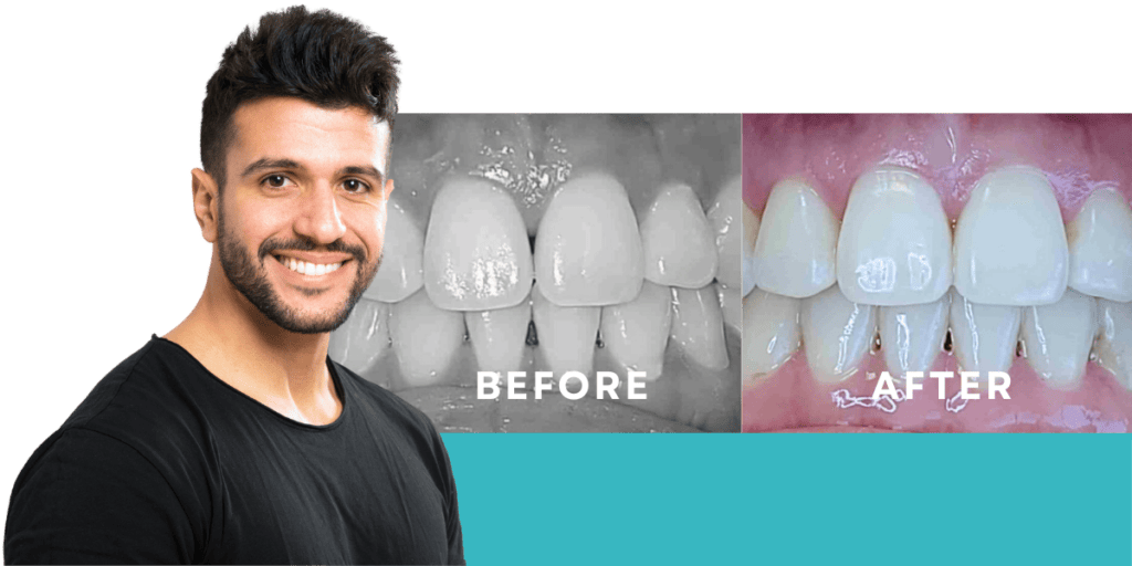 Black Triangle Before & After