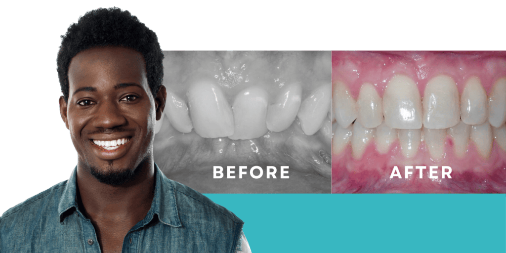 Deep Bite Before & After