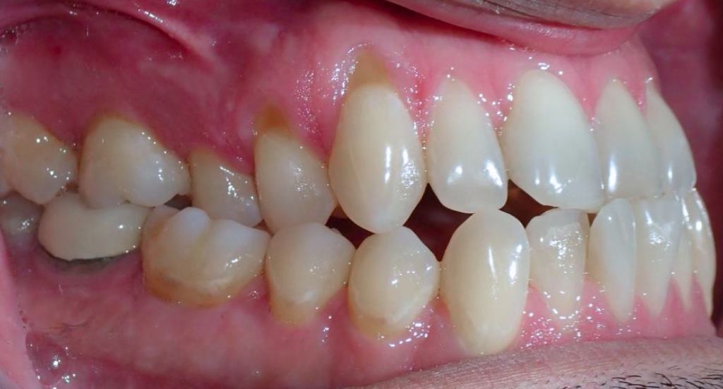 Jaw-Patient-1-Before-1