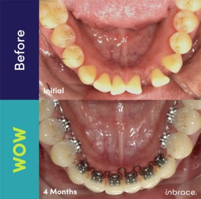 InBrace before and wow